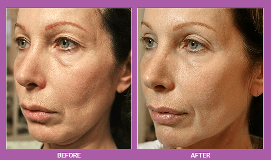 THERMAGE FLX – THE MOTHERS DAY GIFT SHE DIDNT KNOW SHE NEEDED